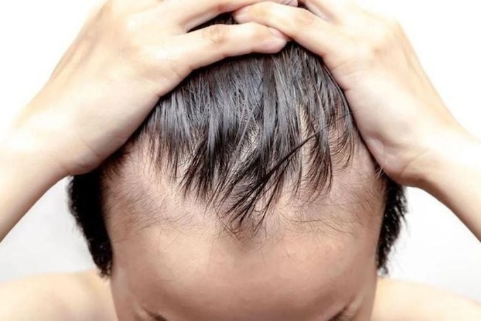 Cách để hết bị hói đầu
