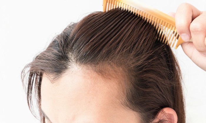 Cách để không bị hói đầu