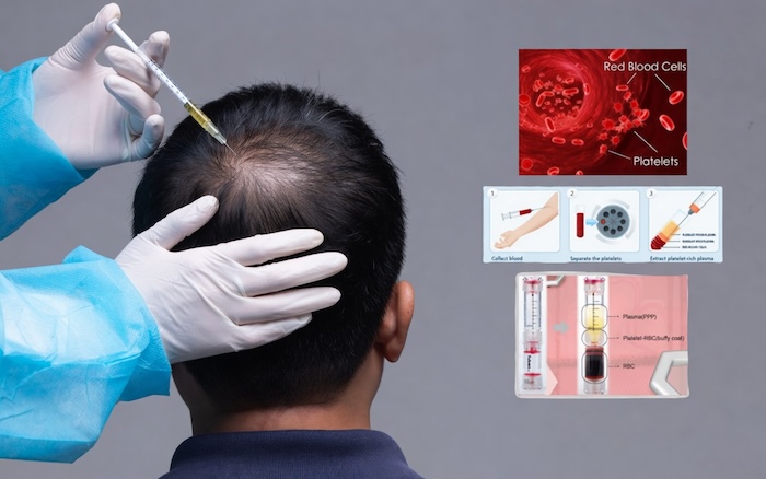 Cách hết hói đỉnh đầu
