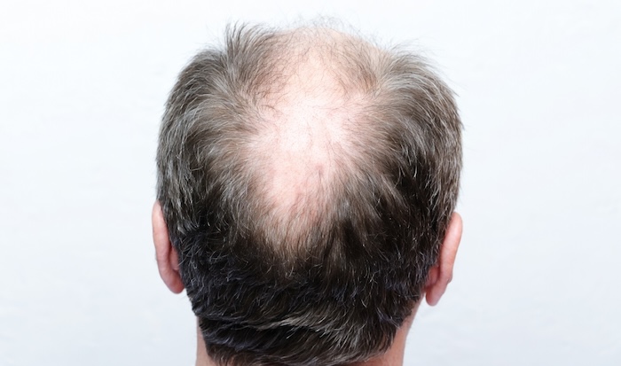 Cách khắc phục hói đầu