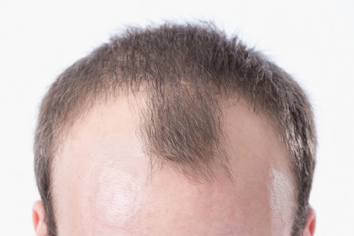 Cách nhận biết bị hói