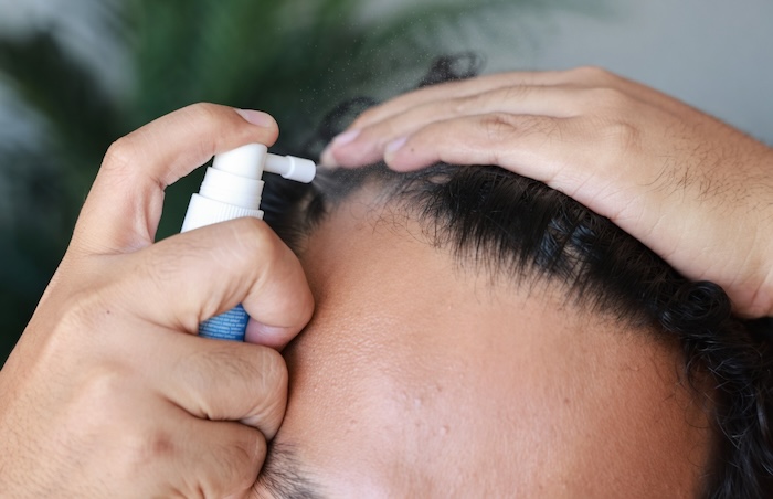 Cách trị hói 2 bên trán