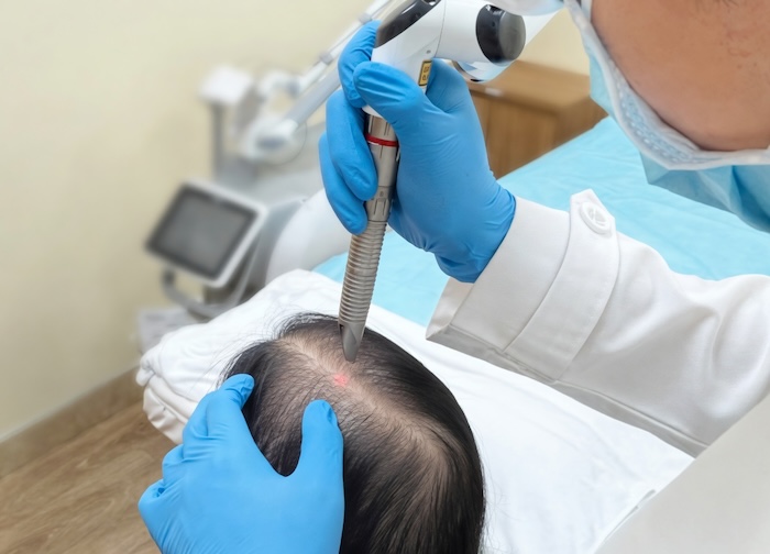 Cách trị hói đầu do di truyền Cách trị hói đầu do di truyền