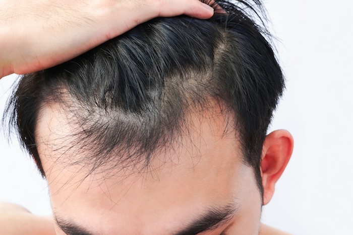 Cách trị hói tóc ở nam