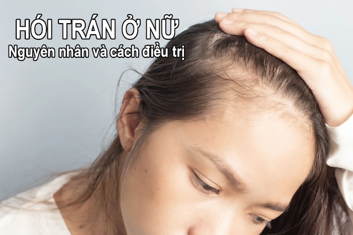 Cách trị hói trán ở nữ