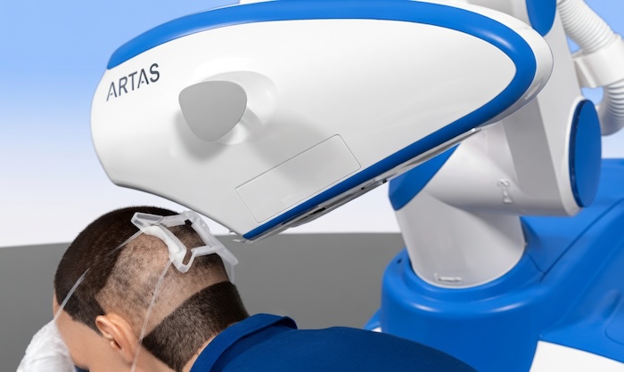 Cấy tóc bằng robot