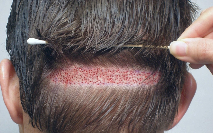 Cấy tóc bao nhiêu 1 nang