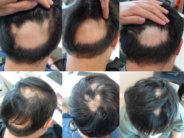 Cấy tóc bao nhiêu tiền