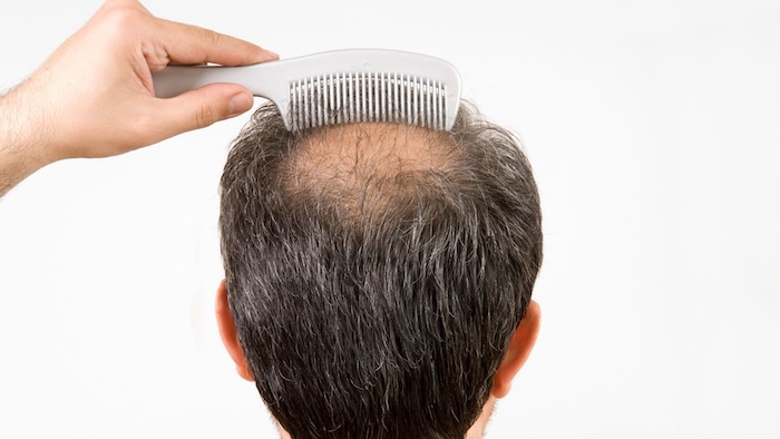 Cấy tóc bao tiền