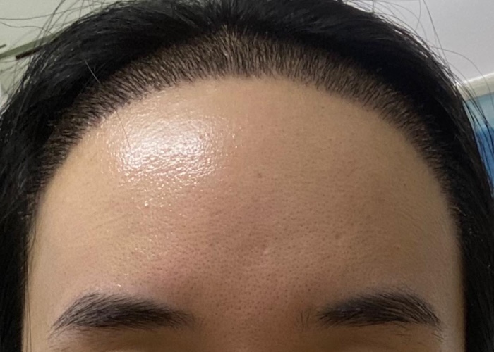 Cấy tóc cho trán cao