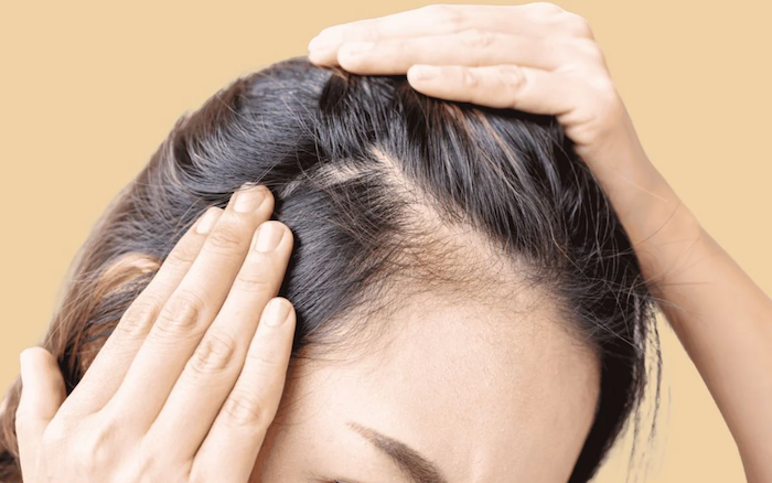 Cấy tóc có bị rụng lại không