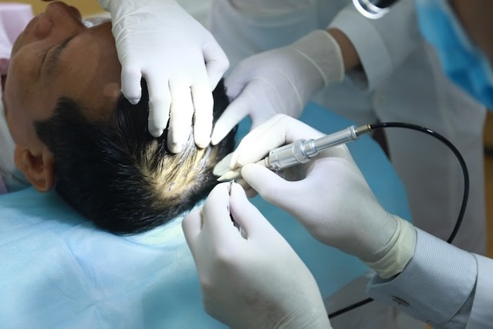 Cấy tóc có đắt không