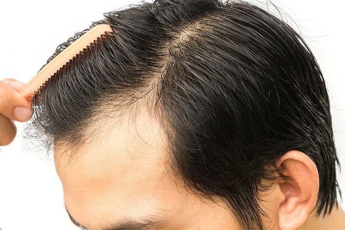 Cấy tóc công nghệ mới