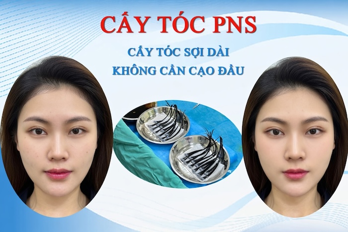 Cấy tóc dài pns
