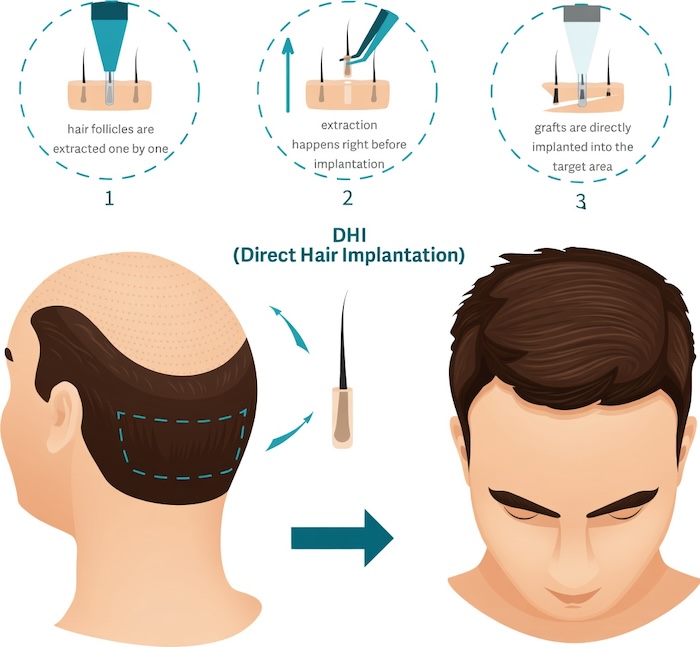 Cấy tóc dhi giá bao nhiêu