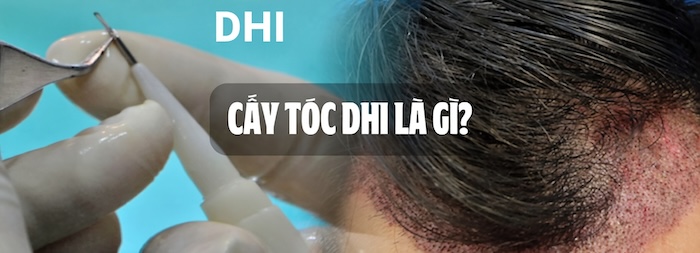 Cấy tóc dhi là gì