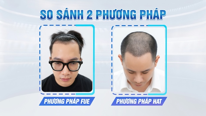 Cấy tóc fue và hat