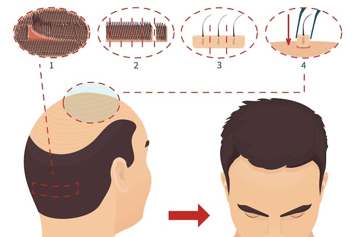 Cấy tóc fut