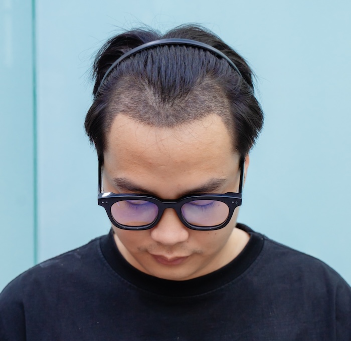 Cấy tóc hói chữ m