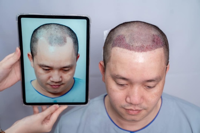 Cấy tóc liệu có hiệu quả