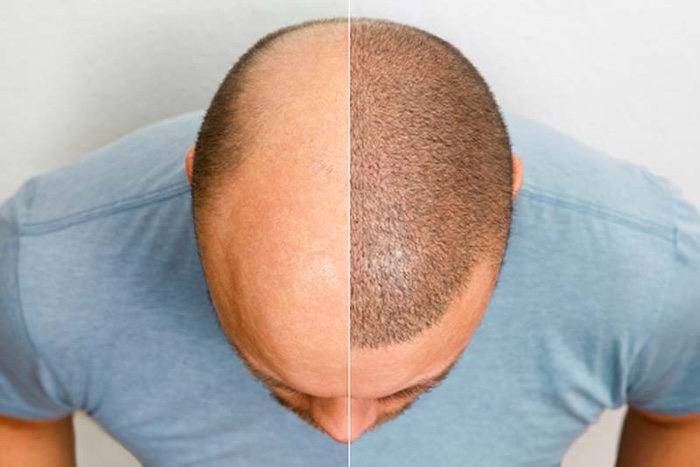 Cấy tóc lông mày black hair hà nội