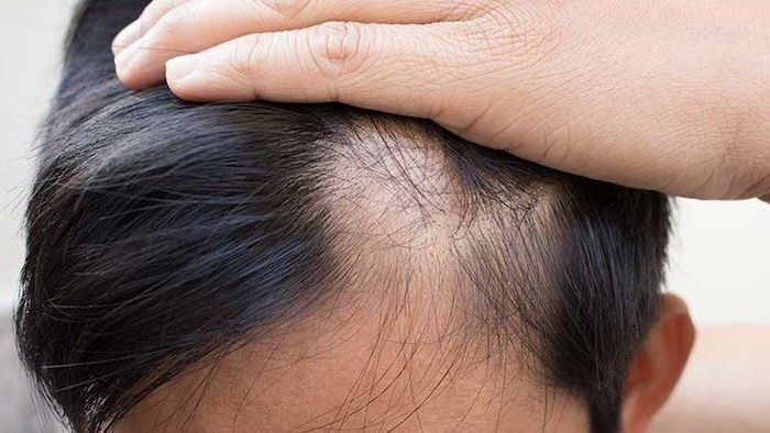 Cấy tóc nam hà nội