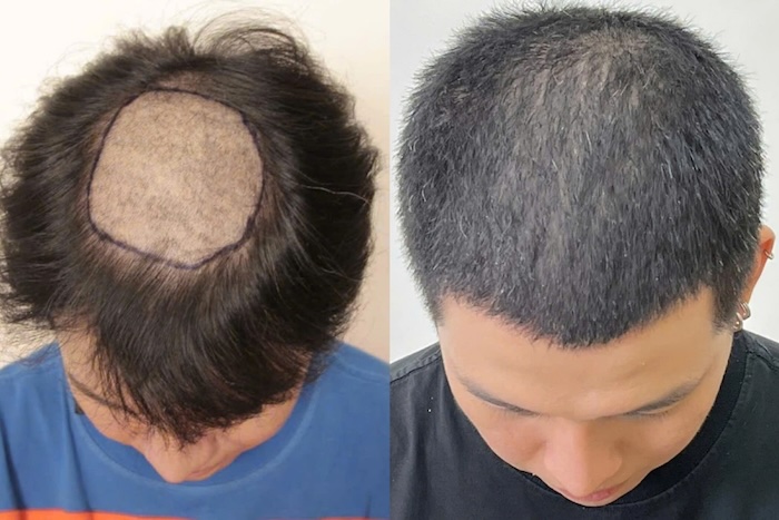 Cấy tóc nghĩa là gì