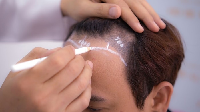 Cấy tóc ở hcm