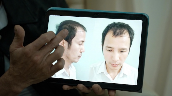 Cấy tóc ở việt nam bao nhiêu tiền