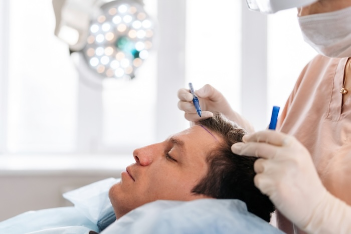 Cấy tóc ở việt nam giá bao nhiêu
