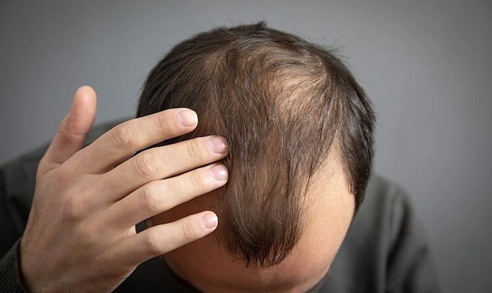 Cấy tóc sinh học bao nhiêu tiền