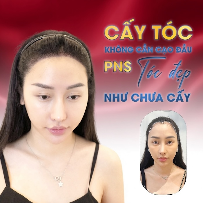 Cấy tóc sợi dài pns