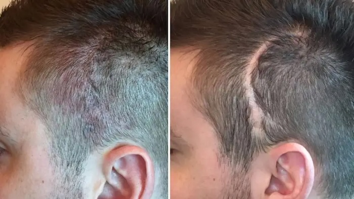 Cấy tóc trên sẹo giá bao nhiêu