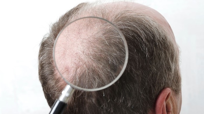 Cấy tóc trị hói giá bao nhiêu