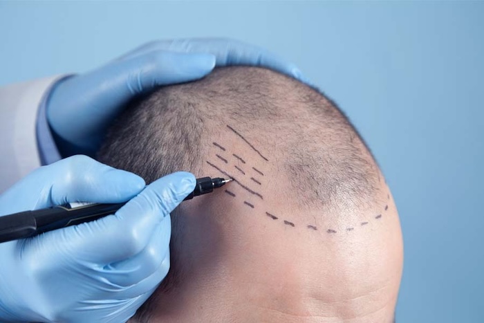 Cấy tóc tự thân chi phí bao nhiêu
