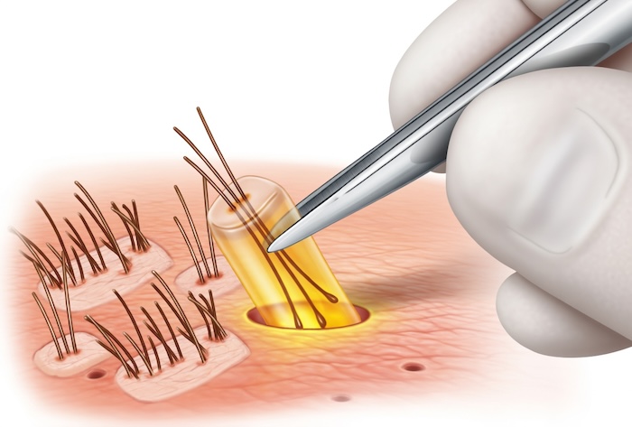 Cấy tóc tự thân có an toàn không