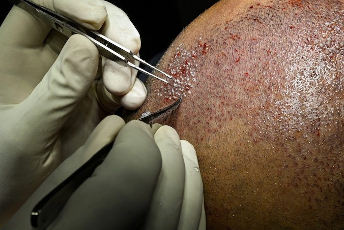 Cấy tóc tự thân có đau không