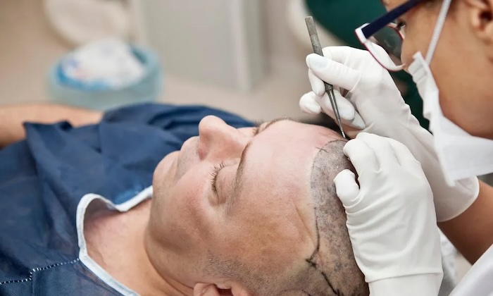 Cấy tóc tự thân có nguy hiểm không