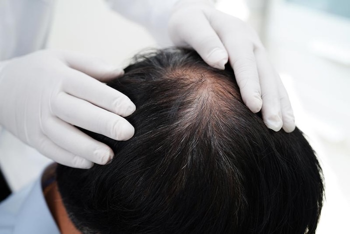 Cấy tóc tự thân là gì