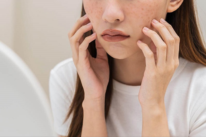 Chân nám dưới da