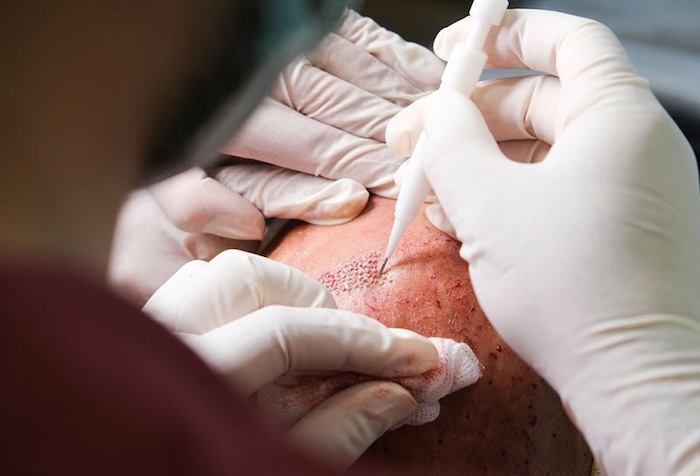 Chi phí cấy tóc ở việt nam