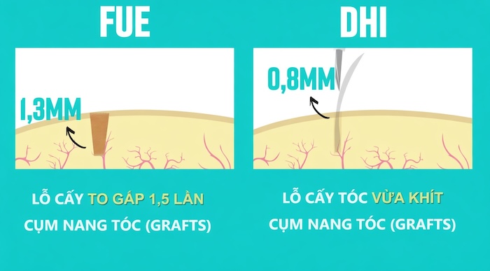 Có bao nhiêu phương pháp cấy tóc