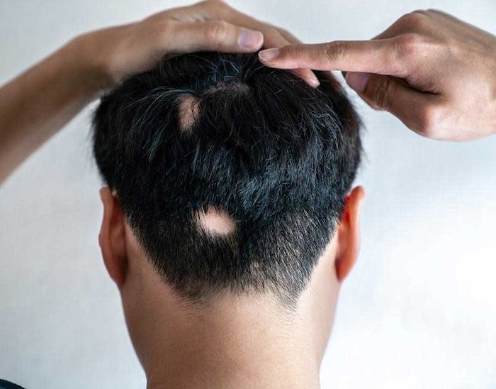 Có nên cấy tóc sinh học không