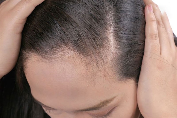 Có nên cấy tóc tự thân