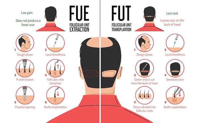 Có những phương pháp cấy tóc nào