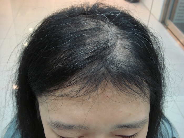 Con gái bị hói