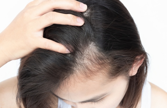 Con gái bị hói đầu Con gái bị hói đầu