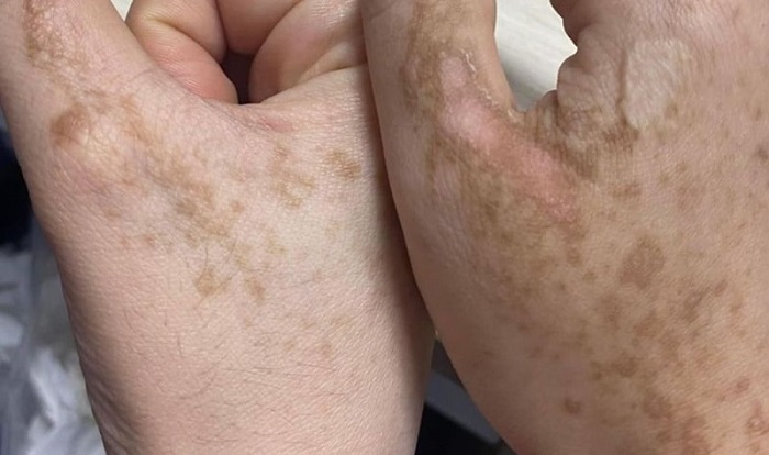 Da cánh tay bị nám