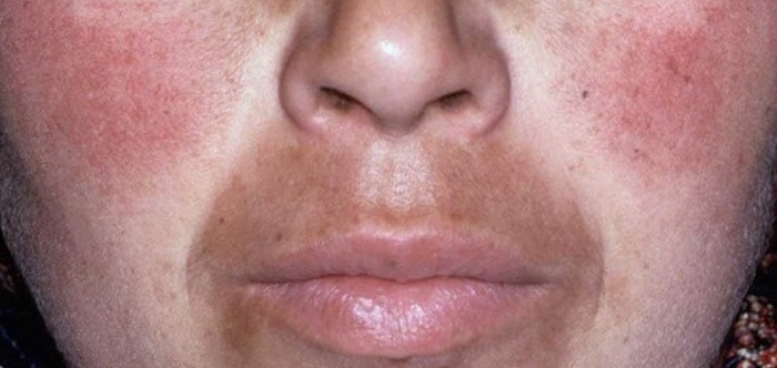 Da mặt bị nám đỏ