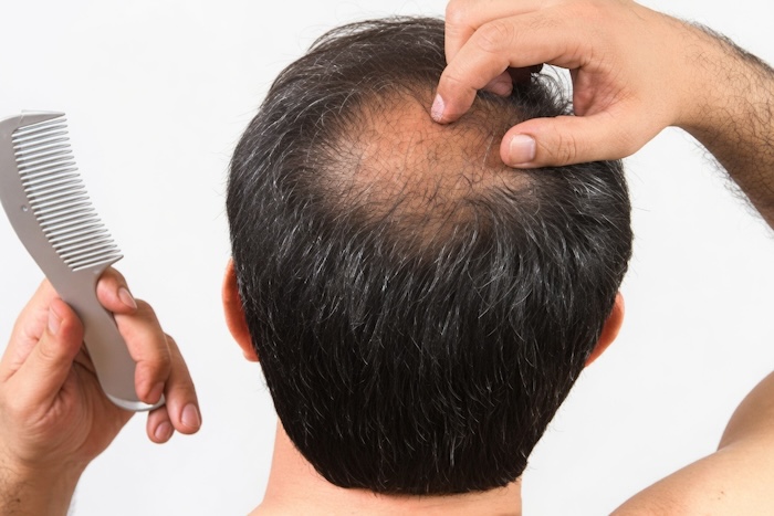 Đầu bị hói